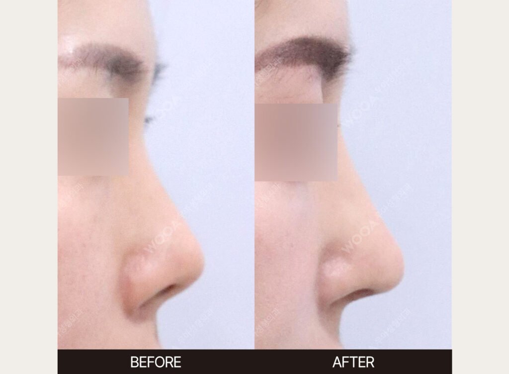 Revision Rhinoplasty before and after – Case 01 – WOOA Plastic Surgery Gangnam