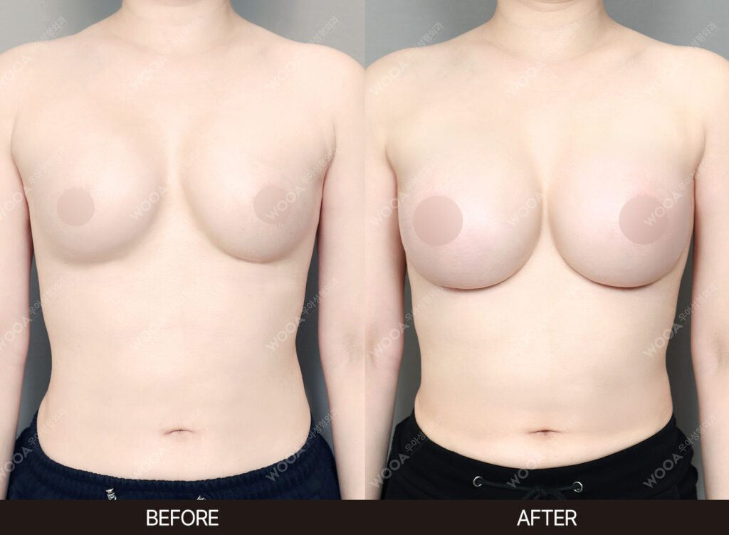 Breast Revision Surgery before and after – Case 13 – WOOA Plastic Surgery Gangnam