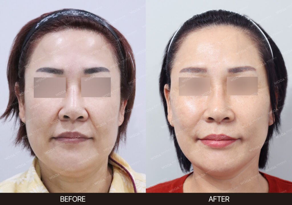 SMAS Facelift before and after – Case 08 – WOOA Plastic Surgery Gangnam