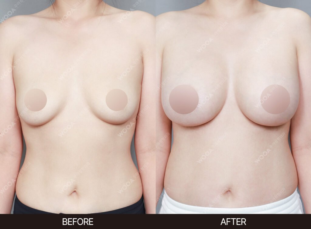 Breast Augmentation before and after – Case 50 – WOOA Plastic Surgery Gangnam