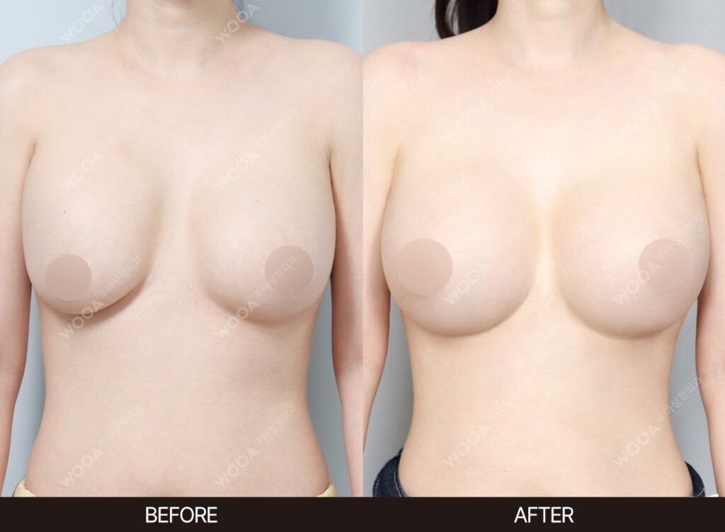 Breast Revision Surgery before and after – Case 08 – WOOA Plastic Surgery Gangnam