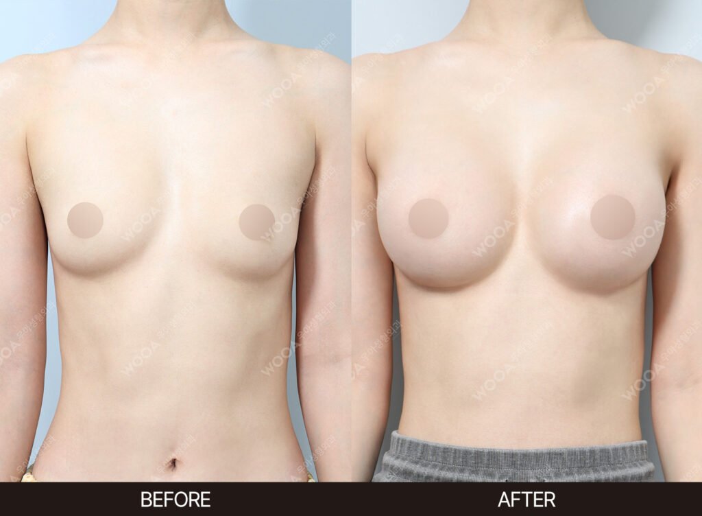 Breast Augmentation before and after – Case 15 – WOOA Plastic Surgery Gangnam