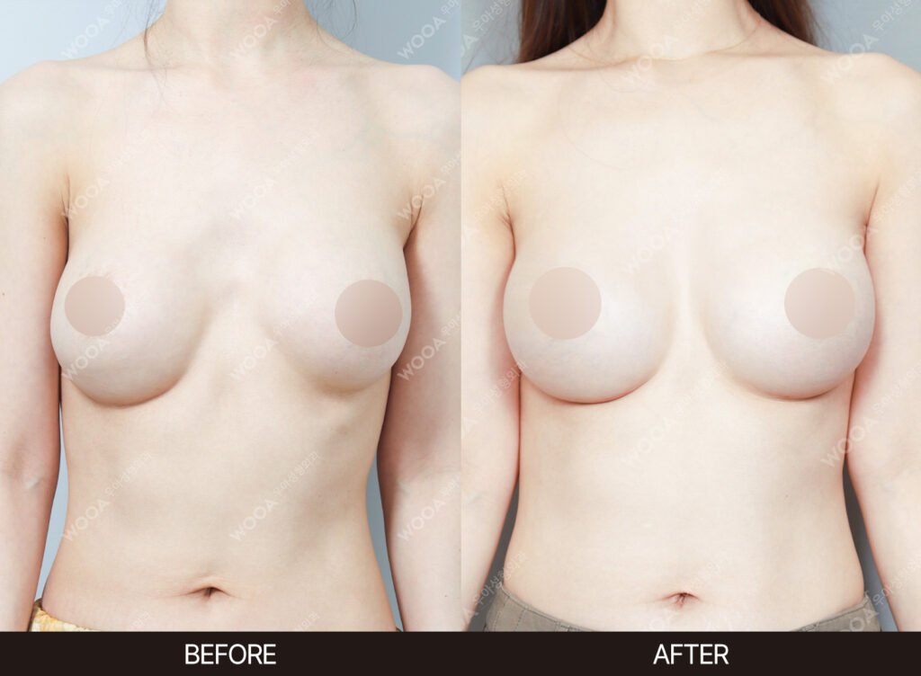 Breast Revision Surgery before and after – Case 09 – WOOA Plastic Surgery Gangnam