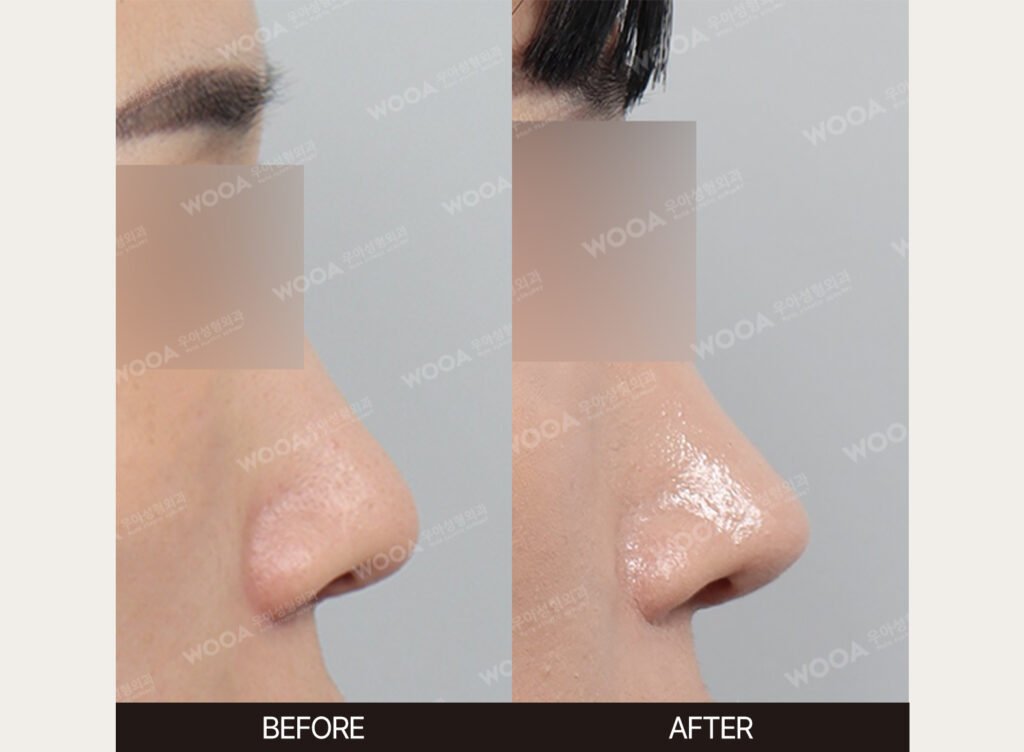 Revision Rhinoplasty before and after – Case 07 – WOOA Plastic Surgery Gangnam