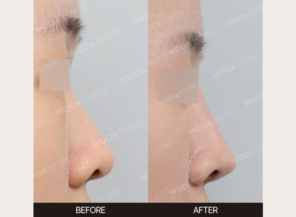 Low Nose Bridge Augmentation before and after – Case 03 – WOOA Plastic Surgery Gangnam