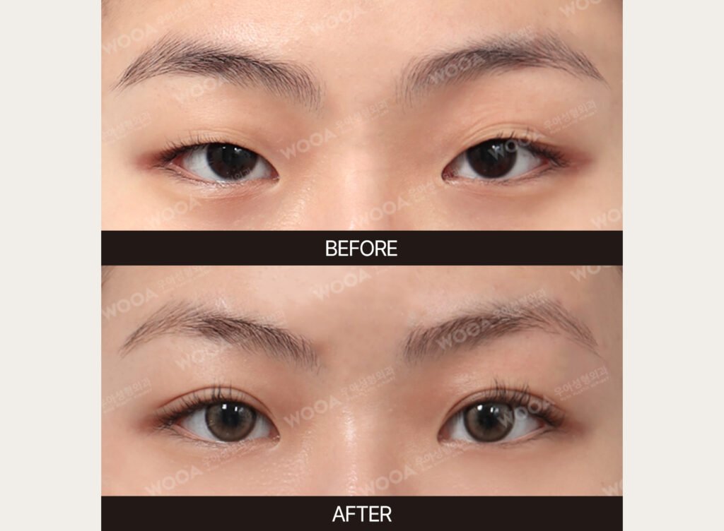 Double Eyelid Surgery before and after – Case 05 – WOOA Plastic Surgery Gangnam