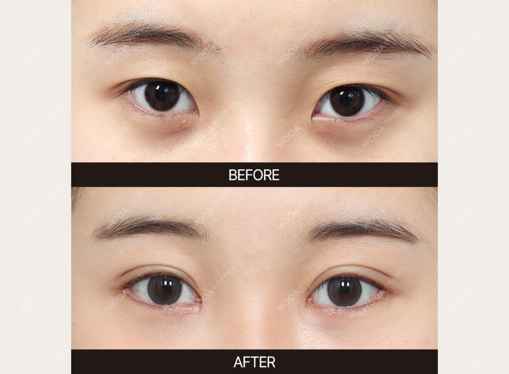 Eye Revision Surgery before and after – Case 06 – WOOA Plastic Surgery Gangnam