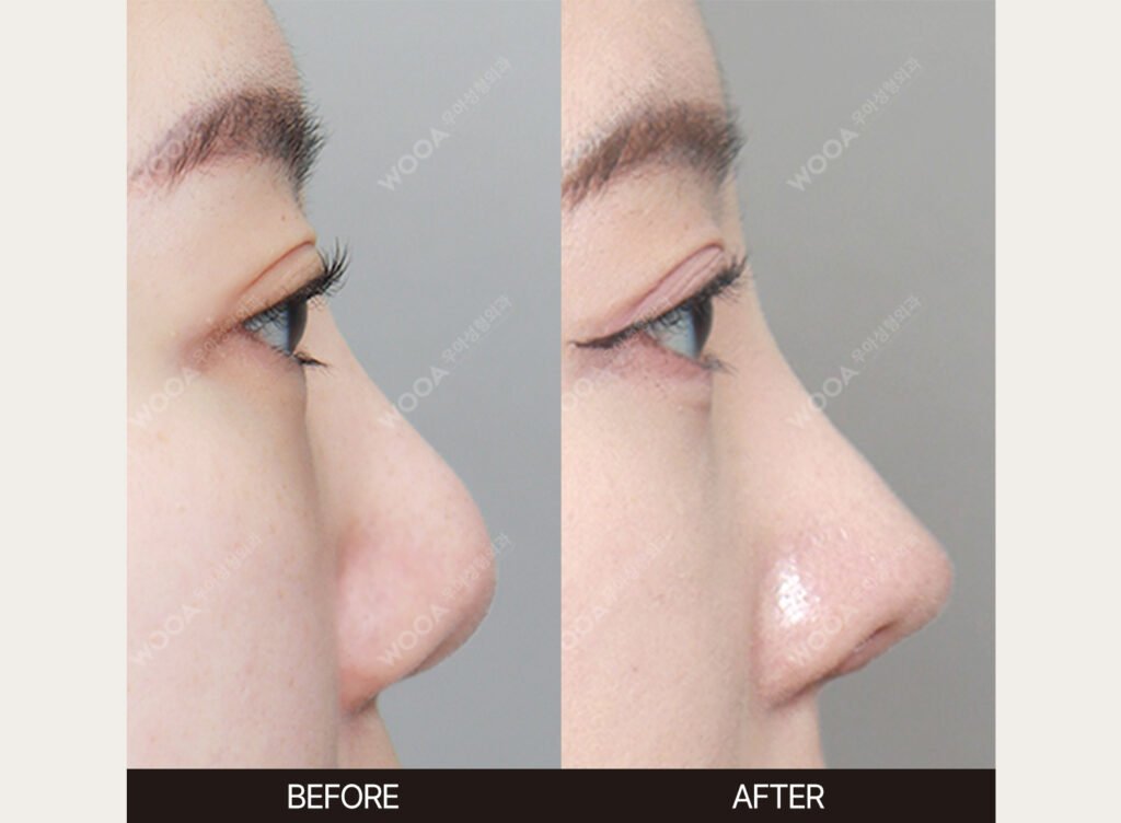 Revision Rhinoplasty before and after – Case 09 – WOOA Plastic Surgery Gangnam