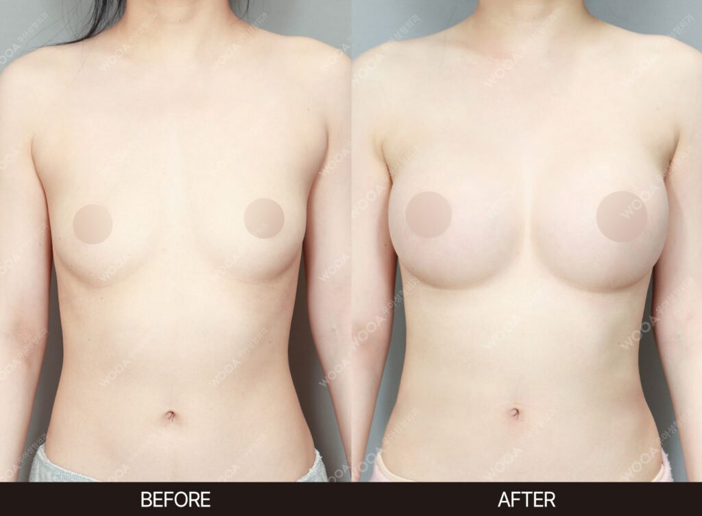 Breast Augmentation before and after – Case 44 – WOOA Plastic Surgery Gangnam