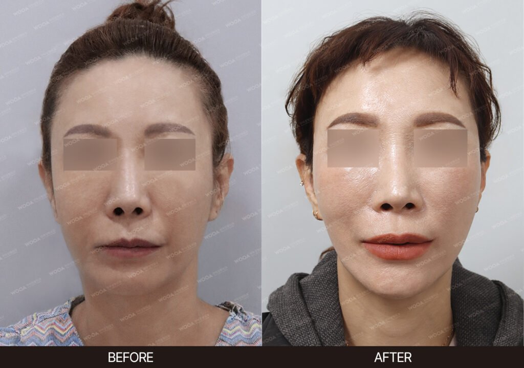 Mini Facelift before and after – Case 01 – WOOA Plastic Surgery Gangnam