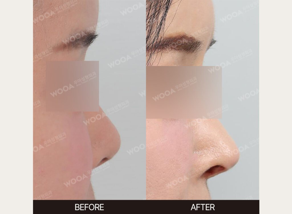 Dorsal Hump Correction before and after – Case 10 – WOOA Plastic Surgery Gangnam