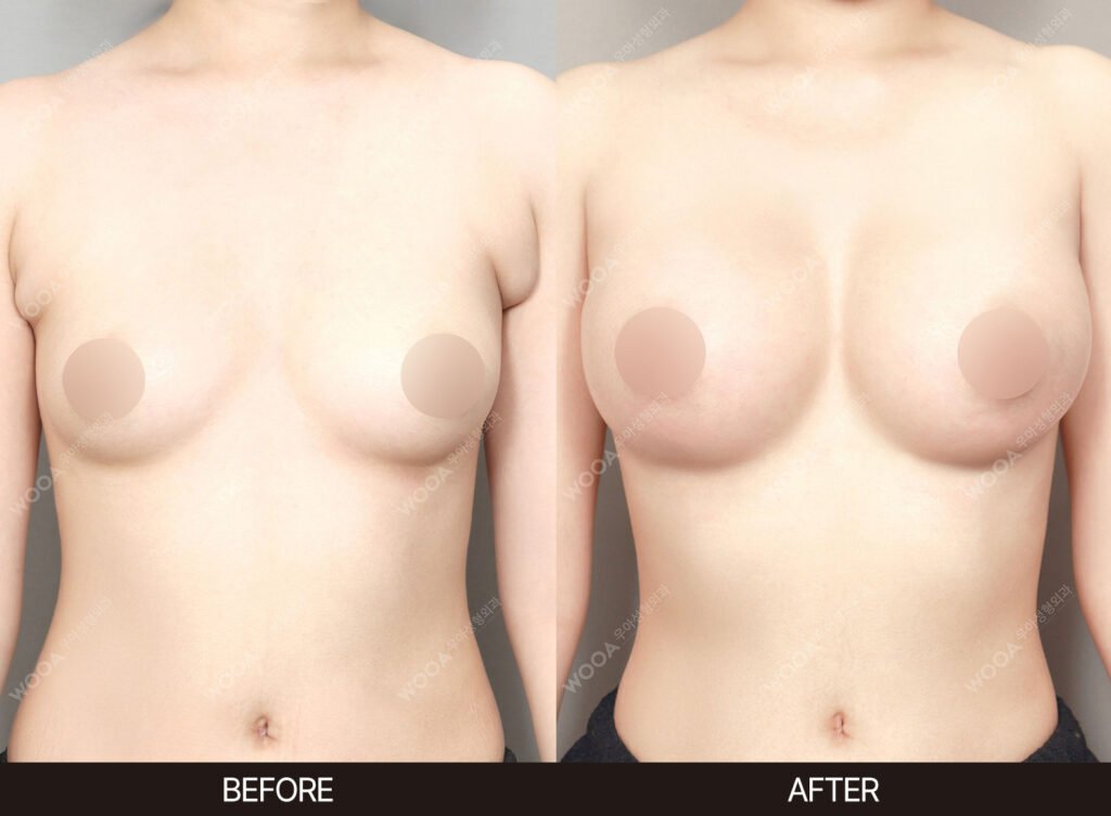 Breast Augmentation before and after – Case 40 – WOOA Plastic Surgery Gangnam