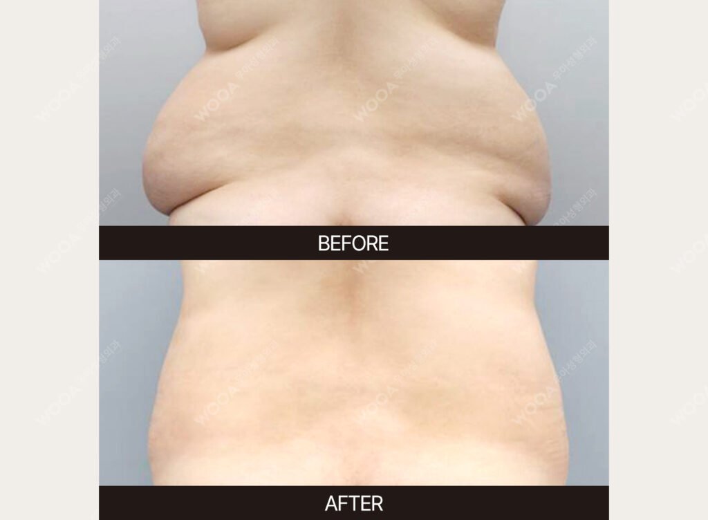 Tummy Tuck (Abdominal Body Lift) before and after – Case 04 – WOOA Plastic Surgery Gangnam