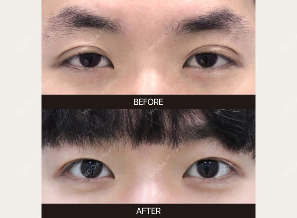 Double Eyelid Surgery before and after – Case 08 – WOOA Plastic Surgery Gangnam