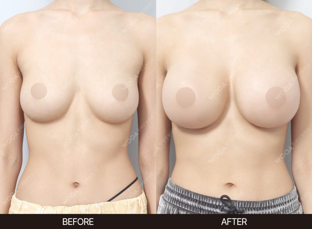 Breast Augmentation before and after – Case 10 – WOOA Plastic Surgery Gangnam