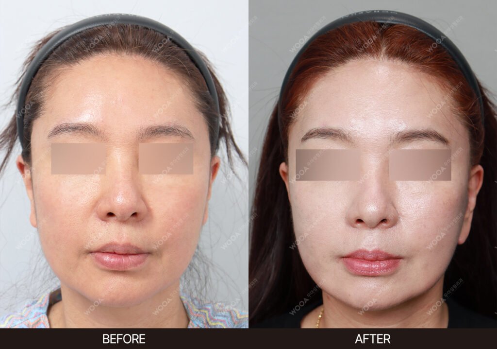 Forehead Reduction Lift before and after – Case 01 – WOOA Plastic Surgery Gangnam