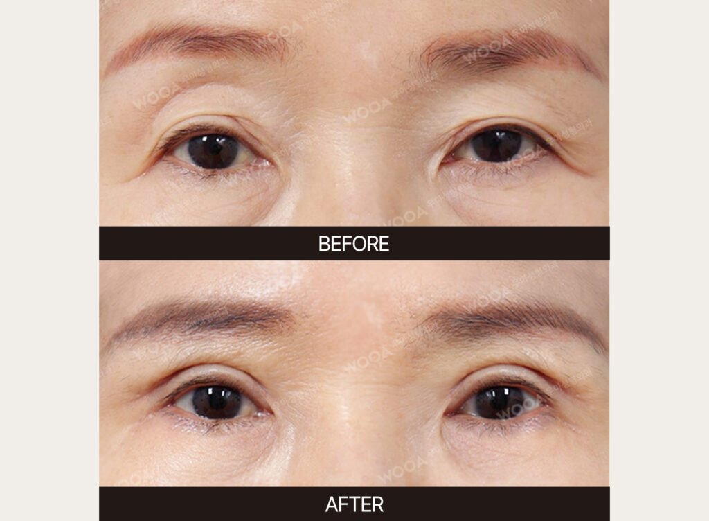 Lower Blepharoplasty before and after – Case 04 – WOOA Plastic Surgery Gangnam