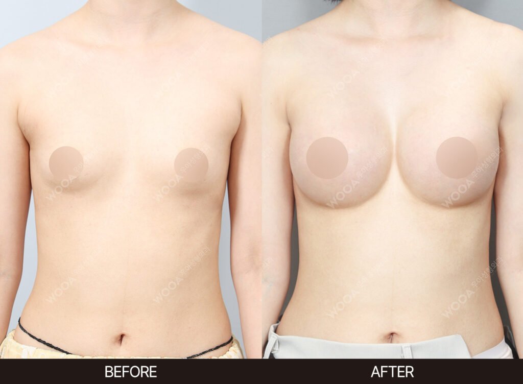 Breast Augmentation before and after – Case 27 – WOOA Plastic Surgery Gangnam