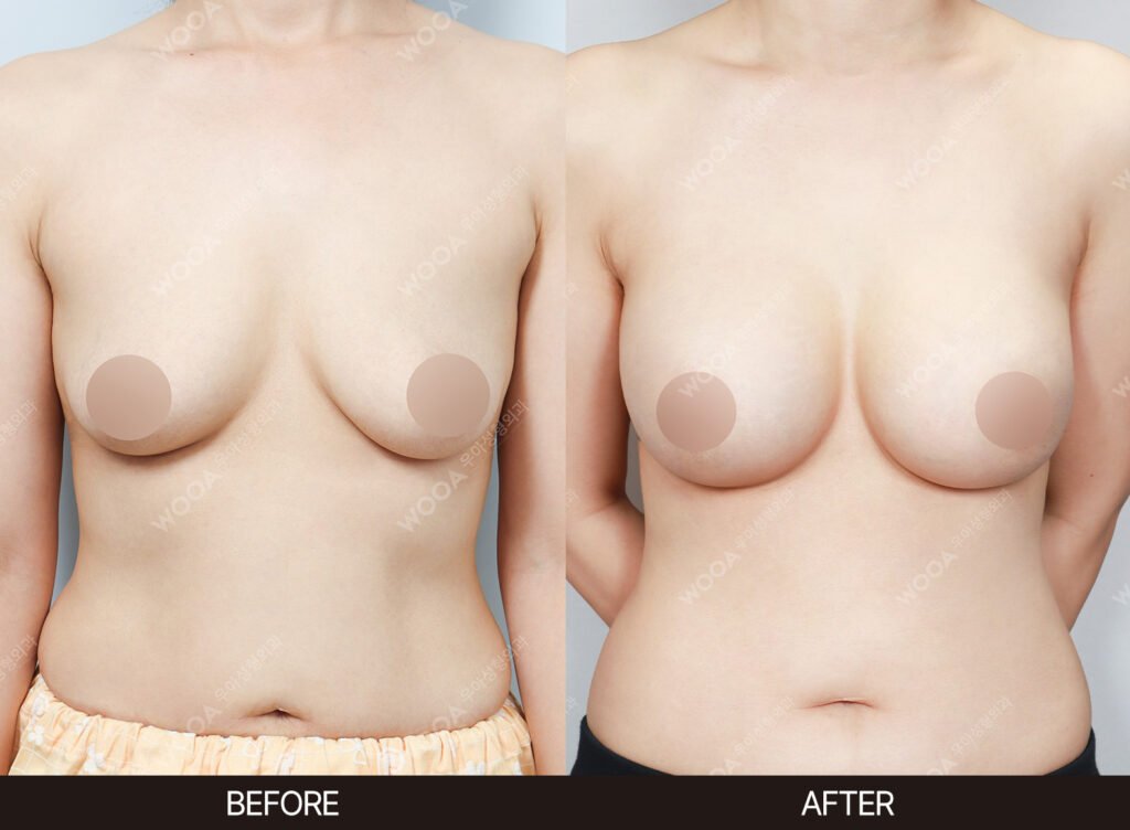 Breast Augmentation before and after – Case 34 – WOOA Plastic Surgery Gangnam