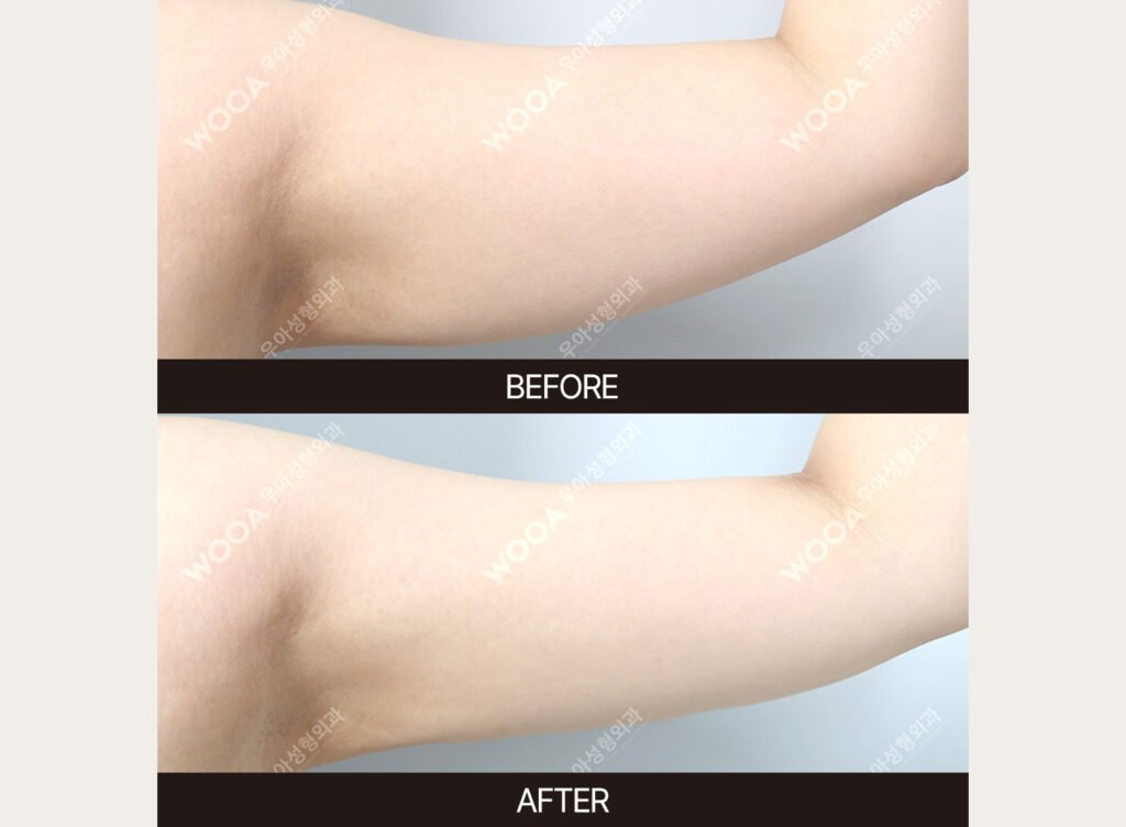 Liposuction before and after – Case 01 – WOOA Plastic Surgery Gangnam