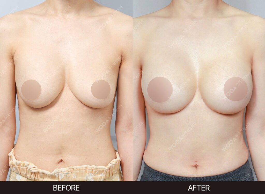 Breast Revision Surgery before and after – Case 06 – WOOA Plastic Surgery Gangnam