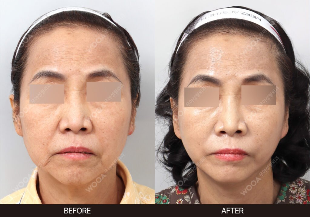 Mini Facelift before and after – Case 02 – WOOA Plastic Surgery Gangnam