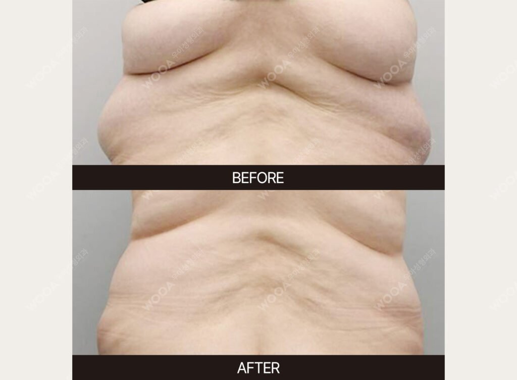 Tummy Tuck (Abdominal Body Lift) before and after – Case 02 – WOOA Plastic Surgery Gangnam