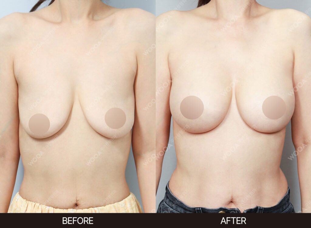 Breast Augmentation before and after – Case 29 – WOOA Plastic Surgery Gangnam