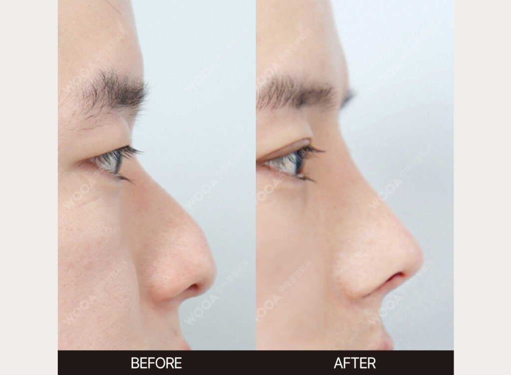 Dorsal Hump Correction before and after – Case 09 – WOOA Plastic Surgery Gangnam