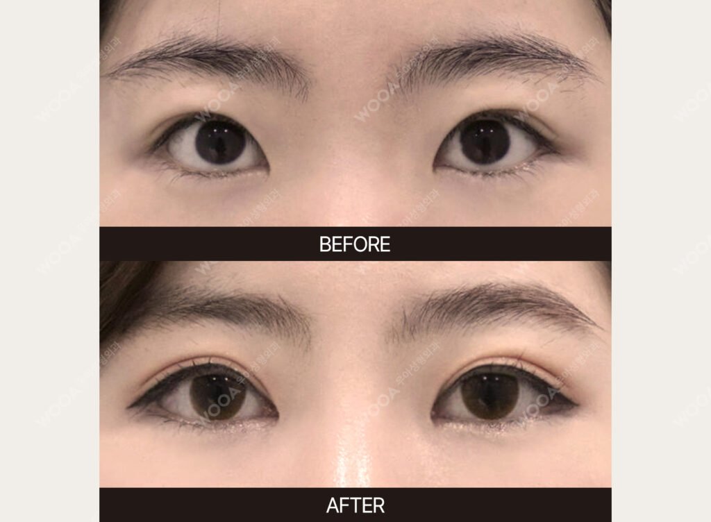 Double Eyelid Surgery before and after – Case 15 – WOOA Plastic Surgery Gangnam