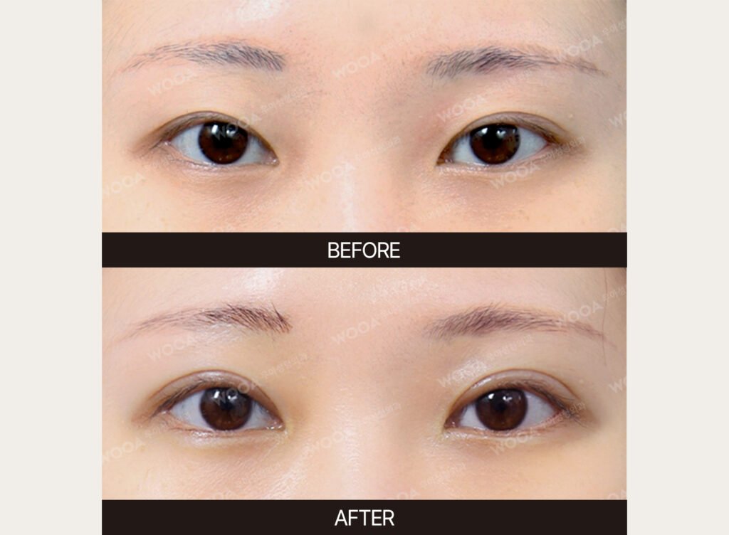 Eye Revision Surgery before and after – Case 01 – WOOA Plastic Surgery Gangnam