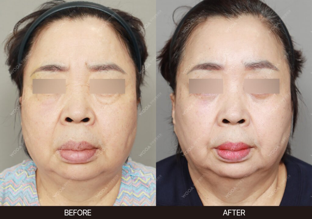 Forehead Lift before and after – Case 06 – WOOA Plastic Surgery Gangnam