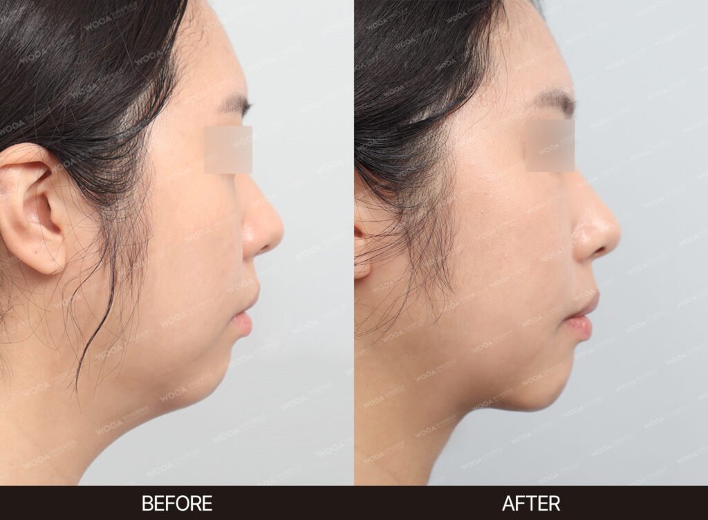 Double Chin Muscle Tightening before and after – Case 06 – WOOA Plastic Surgery Gangnam