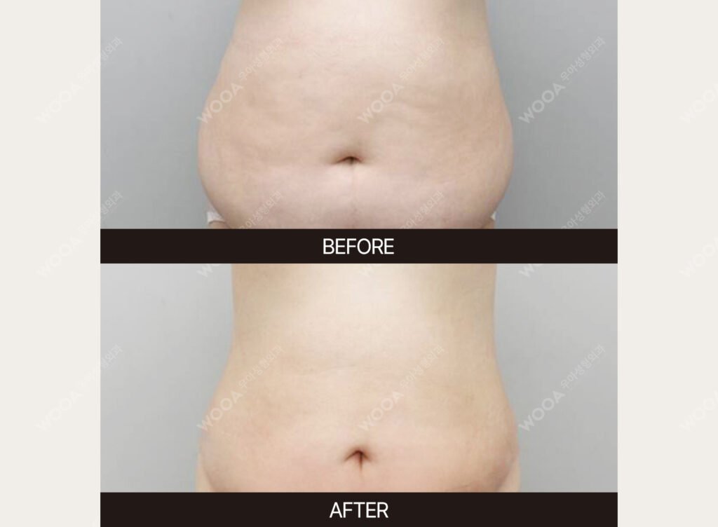 Tummy Tuck (Abdominal Body Lift) before and after – Case 06 – WOOA Plastic Surgery Gangnam