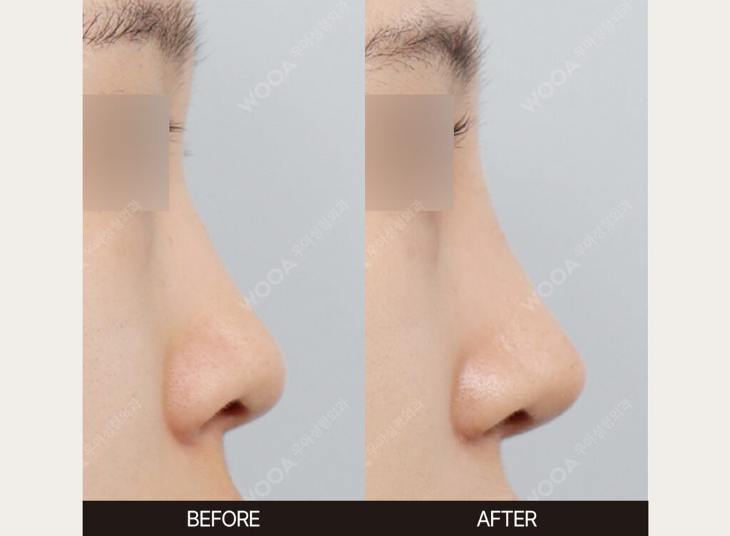 Low Nose Bridge Augmentation before and after – Case 06 – WOOA Plastic Surgery Gangnam