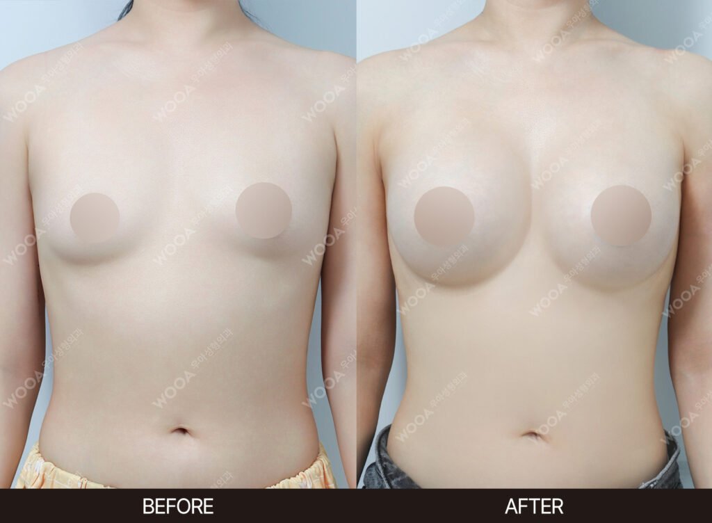 Breast Augmentation before and after – Case 57 – WOOA Plastic Surgery Gangnam