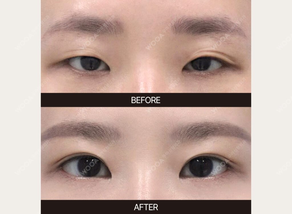 Double Eyelid Surgery before and after – Case 10 – WOOA Plastic Surgery Gangnam