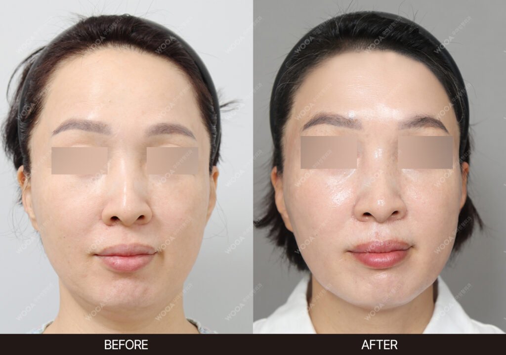 Forehead Reduction Lift before and after – Case 02 – WOOA Plastic Surgery Gangnam