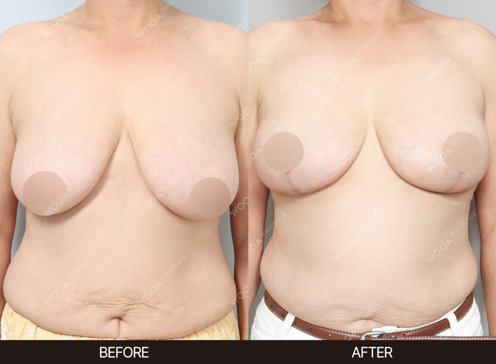 Breast Reduction before and after – Case 02 – WOOA Plastic Surgery Gangnam