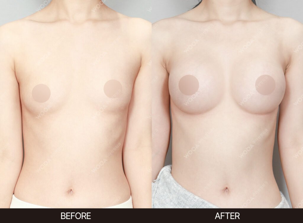 Breast Augmentation before and after – Case 56 – WOOA Plastic Surgery Gangnam