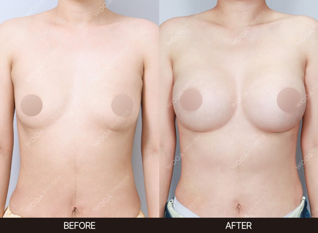 Breast Augmentation before and after – Case 28 – WOOA Plastic Surgery Gangnam