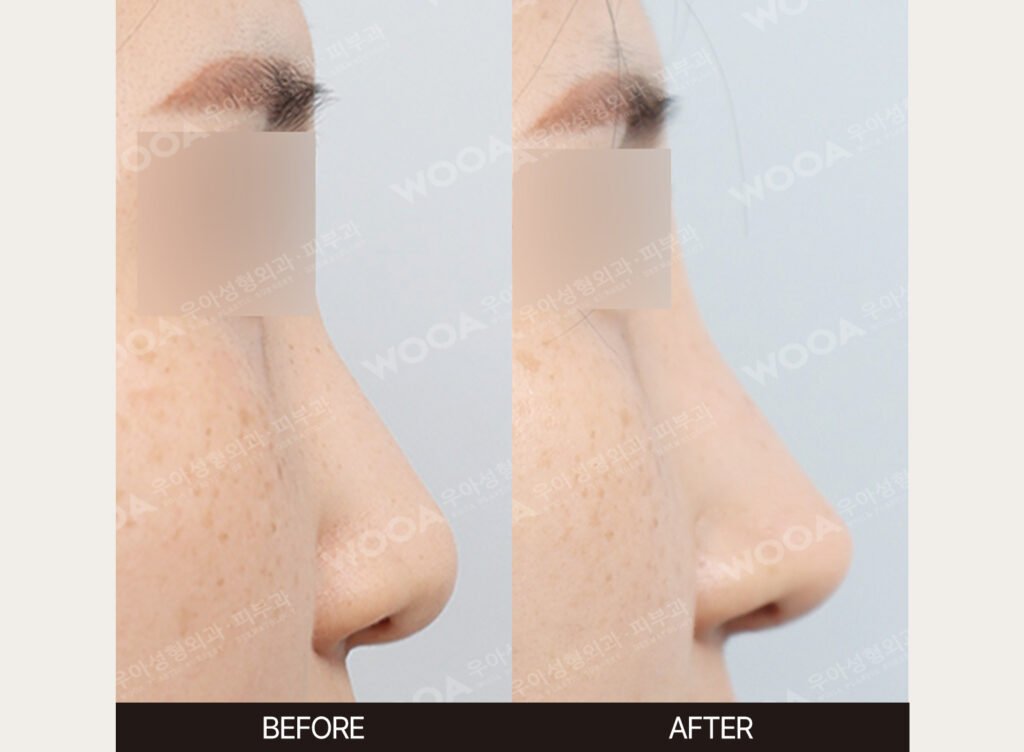Low Nose Bridge Augmentation before and after – Case 08 – WOOA Plastic Surgery Gangnam