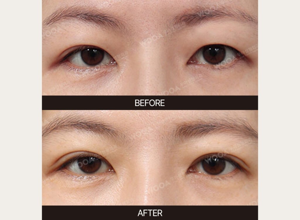 Double Eyelid Surgery before and after – Case 01 – WOOA Plastic Surgery Gangnam