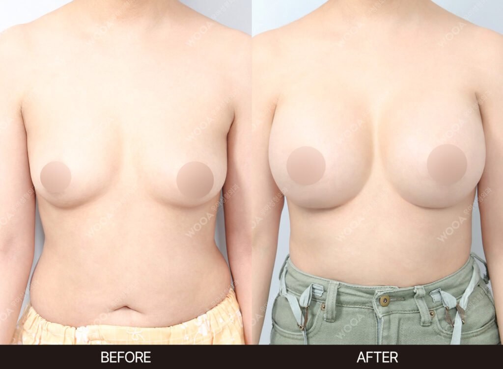Breast Augmentation before and after – Case 02 – WOOA Plastic Surgery Gangnam
