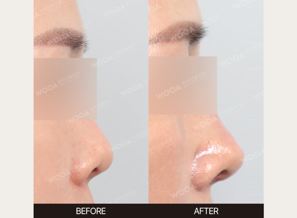 Revision Rhinoplasty before and after – Case 06 – WOOA Plastic Surgery Gangnam