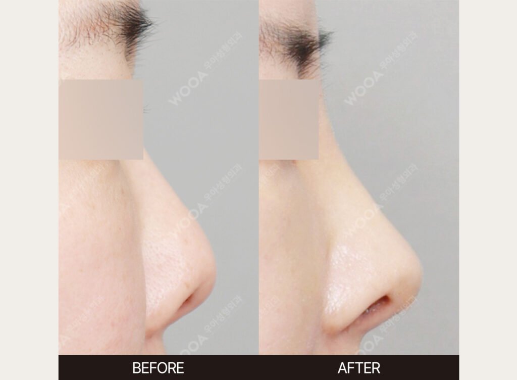 Rib Cartilage Rhinoplasty before and after – Case 01 – WOOA Plastic Surgery Gangnam