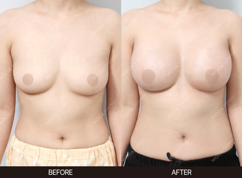 Breast Augmentation before and after – Case 16 – WOOA Plastic Surgery Gangnam