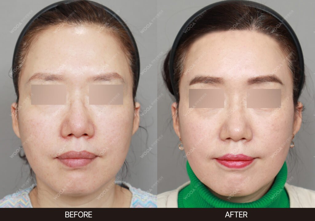 Forehead Reduction Lift before and after – Case 04 – WOOA Plastic Surgery Gangnam