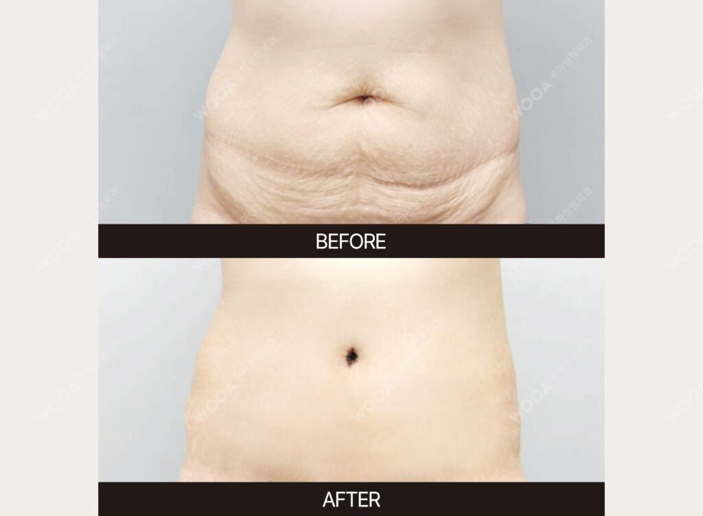 Tummy Tuck (Abdominal Body Lift) before and after – Case 09 – WOOA Plastic Surgery Gangnam