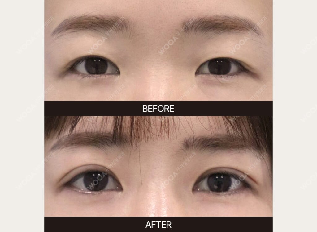 Double Eyelid Surgery before and after – Case 11 – WOOA Plastic Surgery Gangnam